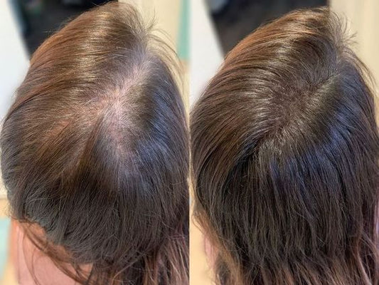 Before and after image of hair regrowth