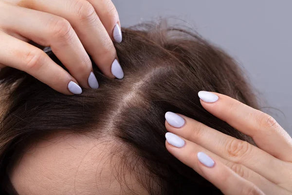 mulher com queda de cabelo. parte central do cabelo feminino mostrando queda de cabelo.