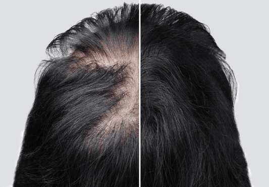 Melhores Tratamentos de Couro Cabeludo para Queda de Cabelo - Glow Headspa