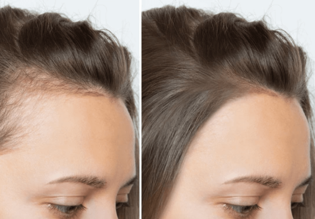 Por que mais mulheres estão ficando carecas? - Glow Headspa